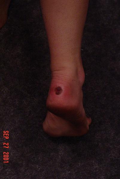 Kayte-s heel after hiking.JPG